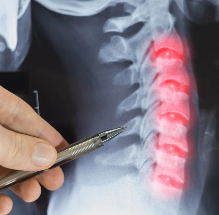 X-ray image of the spine with a highlighted disc area